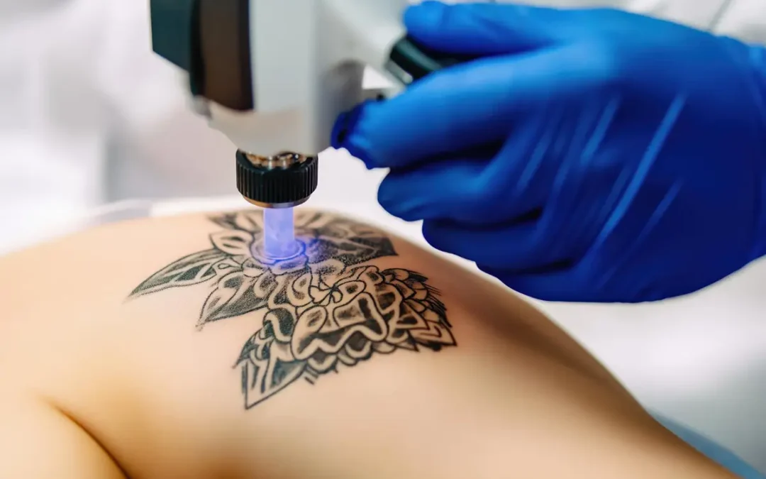 Remoção de tatuagem, um mercado que pode crescer 8,5% nos próximos 5 anos